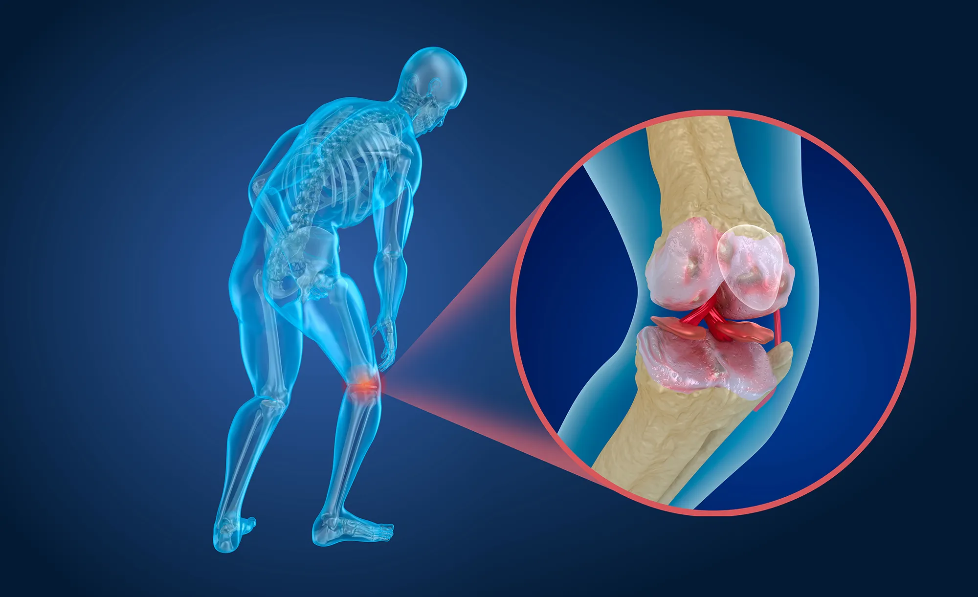 Osteoporosis of the knee joint, Medically accurate 3D illustration
