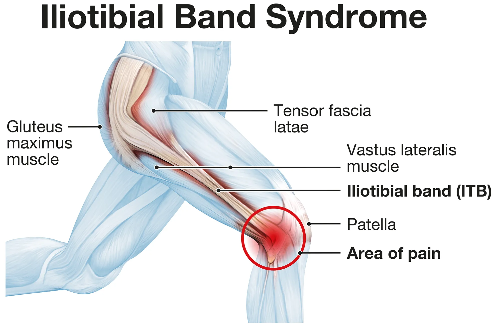  Iliotibial band syndrome, painful knee joint, inflammation or overuse. Illustration
