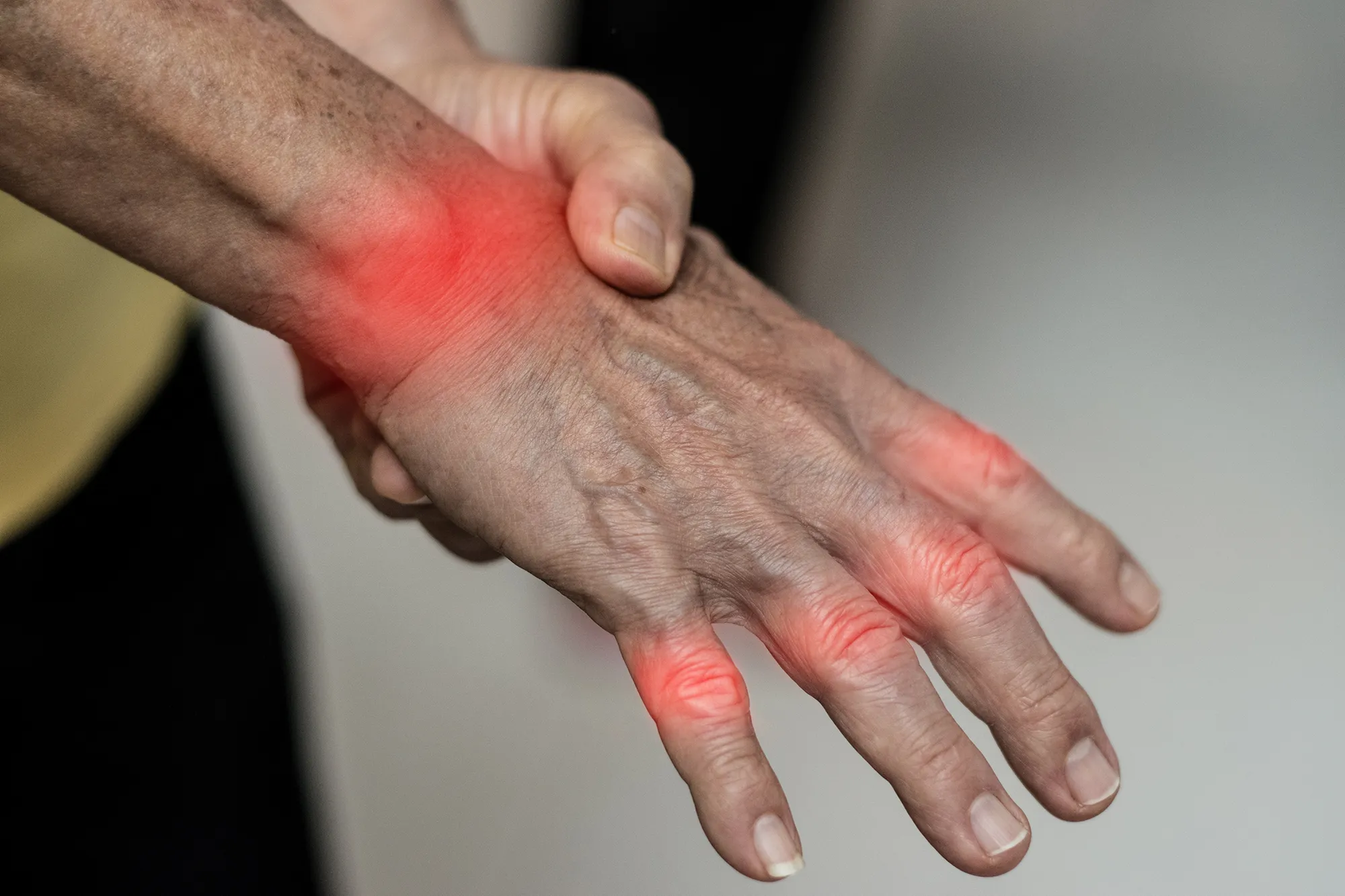 Overuse hand problems. Woman’s hand with red spot o fingers as suffer from Carpal tunnel syndrome. The symptoms of tingling, numbness, weakness, or pain of the fingers and wrist. 