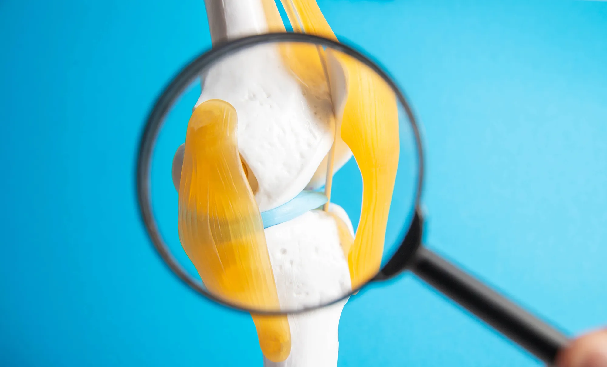 Medical mockup of a knee joint under a magnifying glass on a blue background. Knee ligament rupture and sprain concept. Knee fracture, close-up