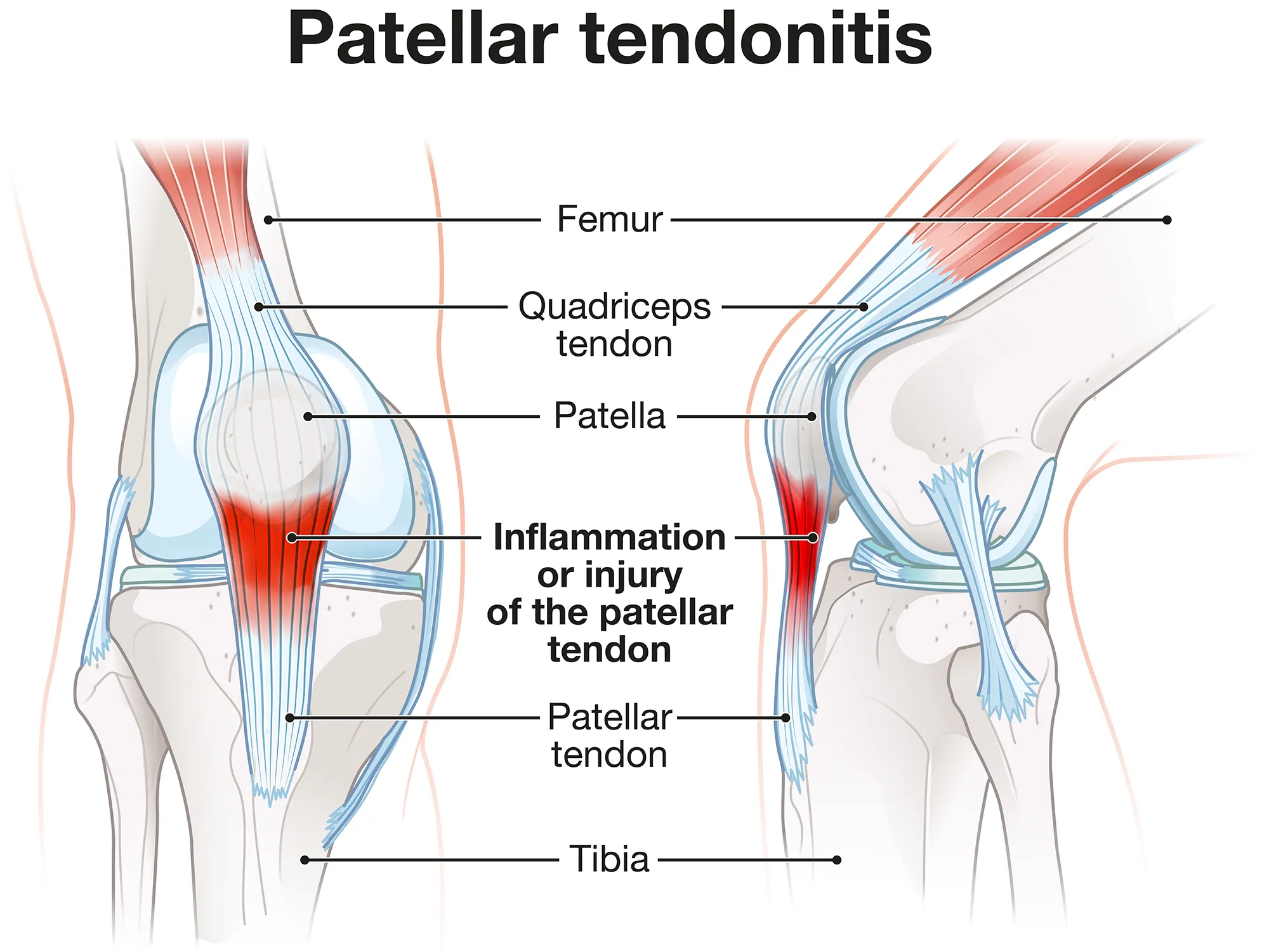 Patellar tendonitis. Jumper's knee. Labeled illustration
