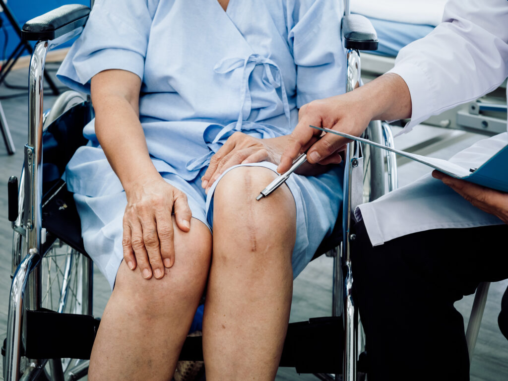 Knee surgery scar. Close-up scars surgical total knee joint replacement on senior or elderly old lady woman patient on wheelchair pointing by pen while doctor holding patient medical record file.
